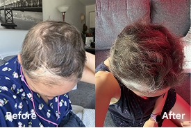 Significant hair growth
